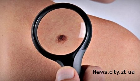 Как проводить скрининг рака кожи в домашних условиях